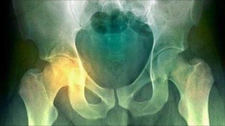 hip fracture