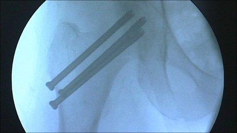 Screws are used to stabilise the hip fracture