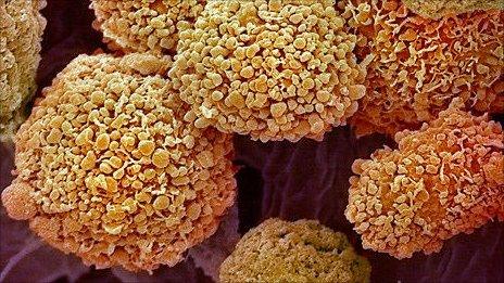 breast cancer cells