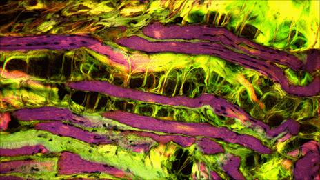 Muscle tissue turning to fat