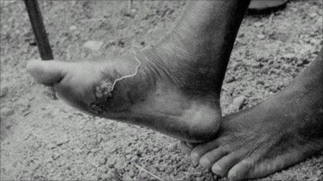 Guinea worm