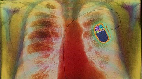 Chest x-ray