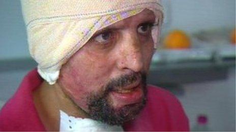 Self-immolation patient "Hosni"