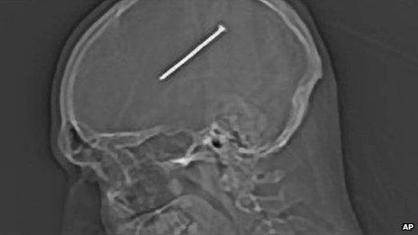 The x-ray of a nail embedded in Dante Autullo's brain 20 January 2012