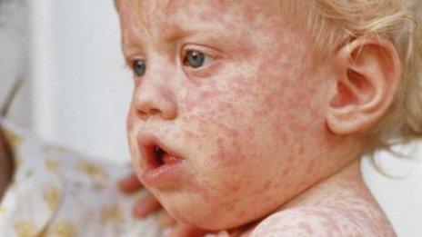 Boy with measles