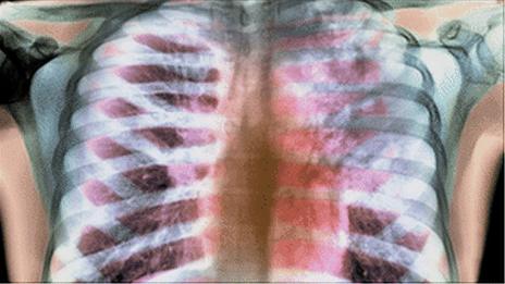 tuberculosis x-ray