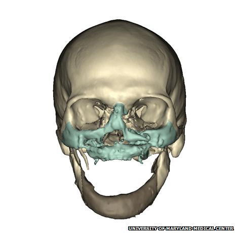 CT scan before face transplant operation (Photo: University of Maryland Medical Center)