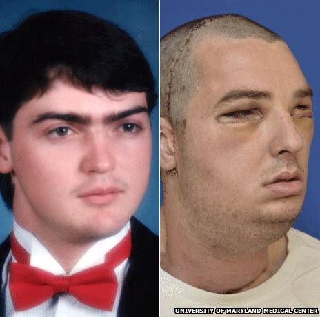 Richard Norris as a student (left) and after his face transplant operation (Photo: University of Maryland Medical Center)