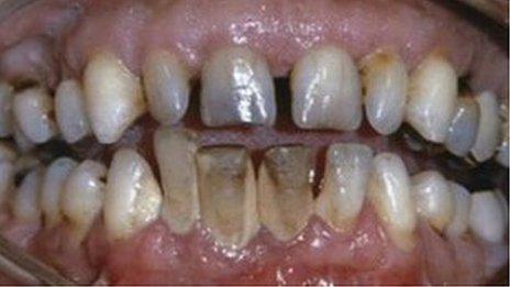 Reports last month suggested NI had the worst teeth in the UK