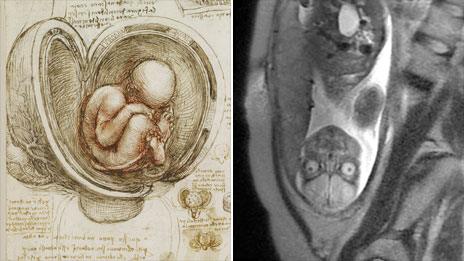 Da Vinci sketch of a baby and a CT image of one