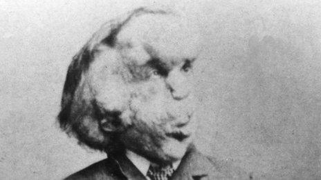 Joseph Merrick