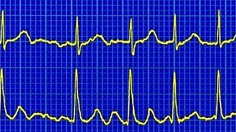 ECG