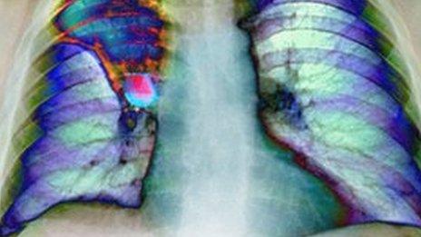 Coloured X-ray of the chest of a patient with a cancer in the right lung (at left).