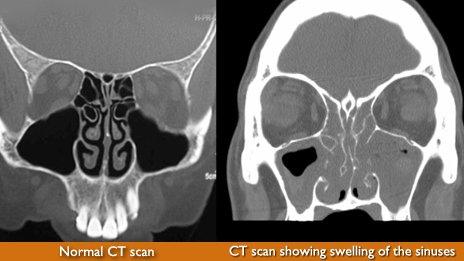 CT scans showing sinus swellings