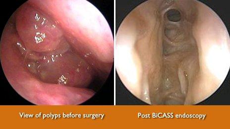 Endoscopic view inside the nose