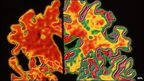 Alzheimer's brain (left) compared with healthy brain (right)