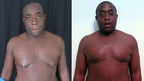 Ayo Adesina before and after surgery