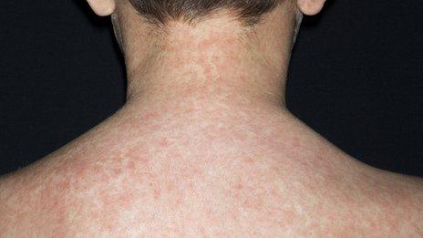 Boy with measles rash