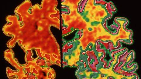 Alzheimer's brain on the left, normal brain on the right