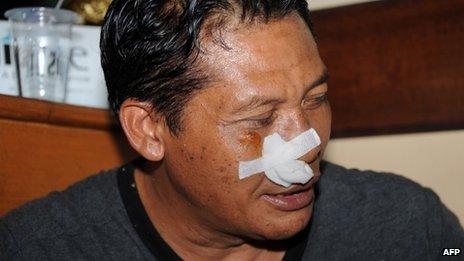 A survivor of the crash sits in hospital in Kedongan, near Denpasar, 13 April