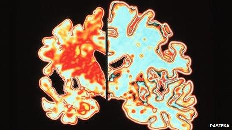 Scan of a brain of an Alzheimer's patient which shows significant signs of shrinking compared to a normal brain.