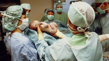 Baby being born by caesarean section