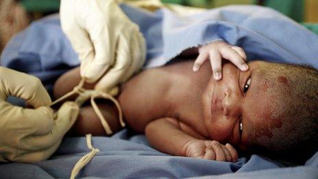 A baby having its cord tied before it is cut