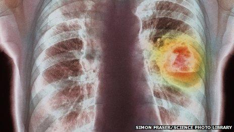 X ray of a chest showing lung cancer