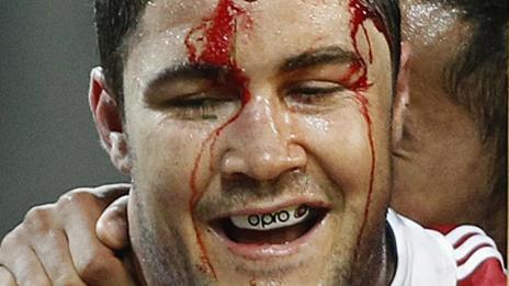 Bradley Barritt bleeds from a head injury