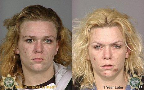 "Before" and "After" pictures of a crystal meth addict