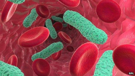 Bacterial infection of the blood causing sepsis