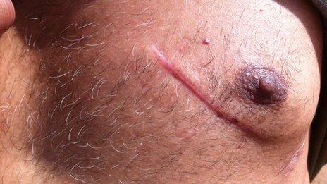 A Pakistani immigrant in Greece shows a scar following a stabbing by suspected Golden Dawn supporters