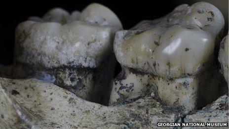 Toothpick lesion on hominid teeth