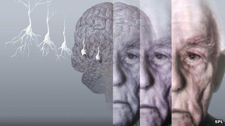 Alzheimer's brain