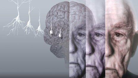 Alzheimer's brain