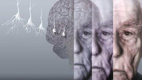 Alzheimer's disease