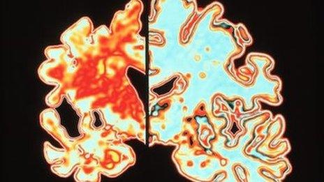 Scan of a brain of an Alzheimer's patient which shows significant signs of shrinking compared to a normal brain.