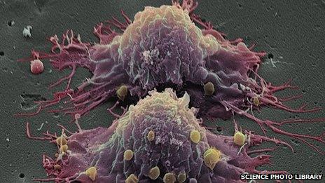 Bowel cancer cells dividing