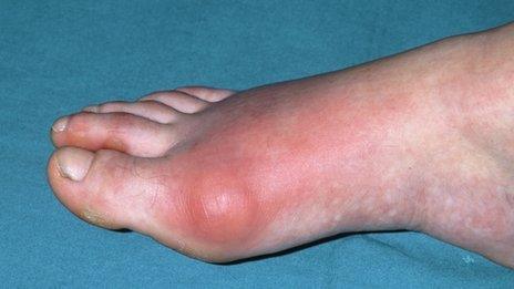 Gout in the foot