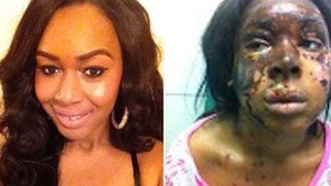 Naomi Oni before and after acid attack