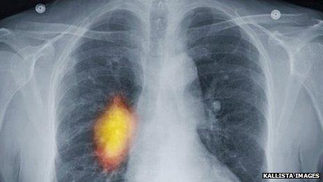 A chest X-ray showing cancer in the right lung.