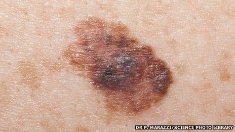 melanoma