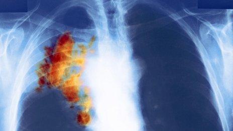 Lung cancer seen in colour X-ray