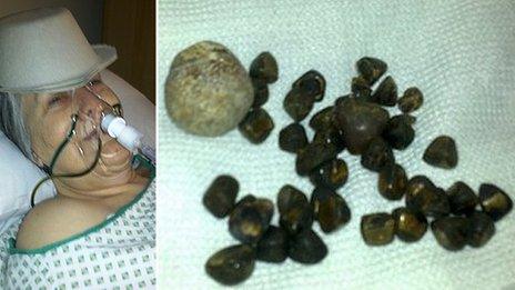 Anita Crawley and her gallstones