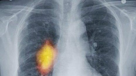 A chest X-ray showing cancer in the right lung.