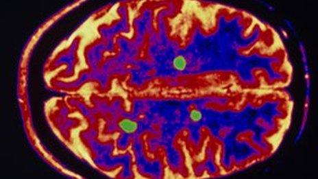 Scan of Multiple Sclerosis