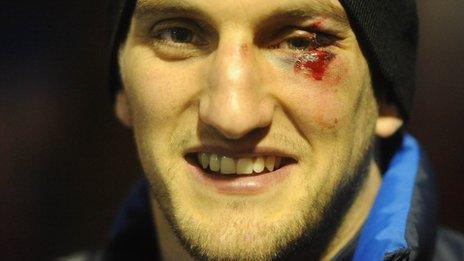 Cardiff Blues director of rugby Mark Hammett says Wales captain Sam Warburton did not suffer any serious injury