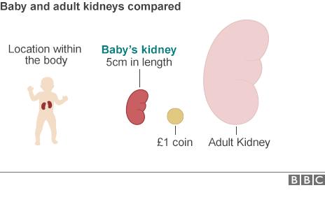 Graphic comparing size of baby's kidney with adult's kidney