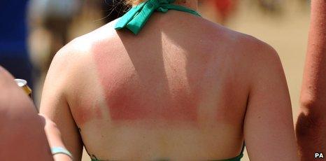 Girl with sunburn at this year's Glastonbury Festival