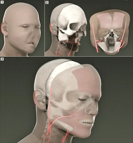 Full face transplant